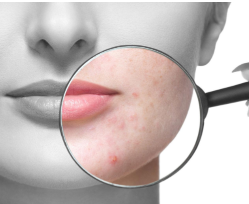 Dlaczego pojawia się trądzik i jak go skutecznie leczyć?